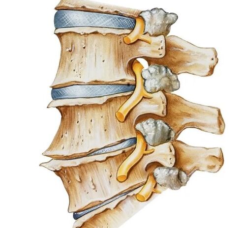Nerve sting in the spine