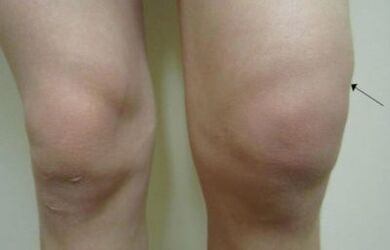 Clinical manifestations of joint joints of the knee