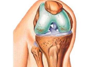 The main causes of knee arthritis