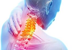 Symptoms of cervical osteochondicity and diet rules for diseases