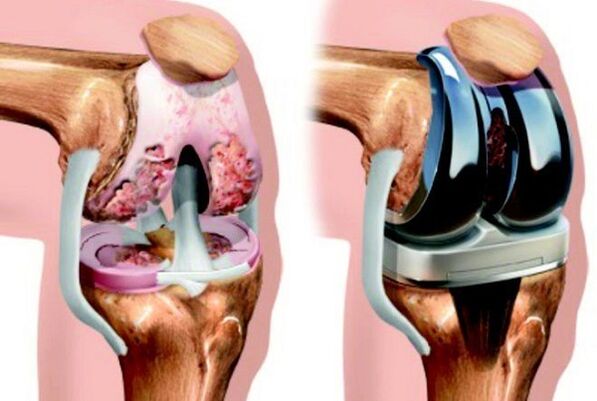 Before and after the knee joint's impact with arthritis