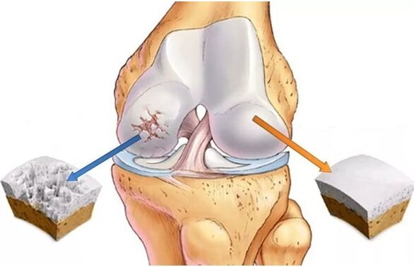 Healthy cartilage and cartilage affected by arthritis