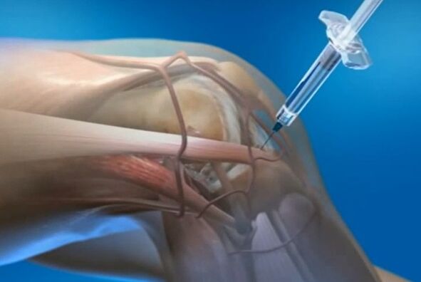 Intra -sectional injections for articulation arthritis