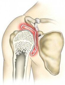destruction of the shoulder joint due to arthropathy