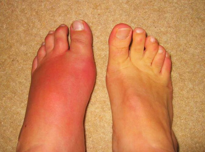 pain in the joints of the legs due to gout