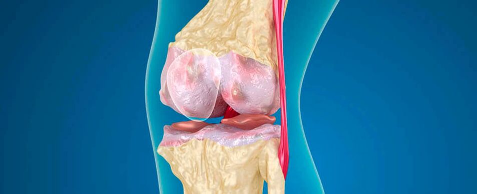 arthropathy of the knee joint